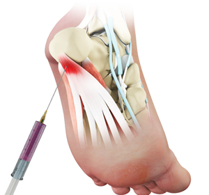 PRP for Plantar Fasciitis - Educational Picture