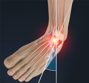 Sprains and Strains - Educational Picture