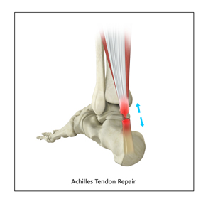 Tendon Injuries - Educational Picture