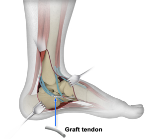 Tendon Repair Surgery - Educational Picture