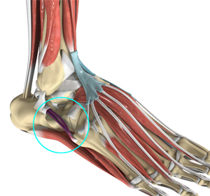 Tendonitis - Educational Picture