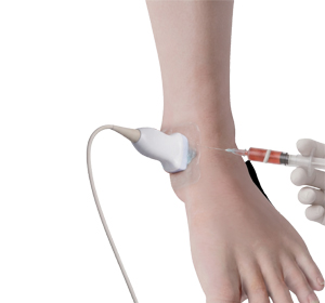 Ultrasound-guided PRP injections - Educational Picture