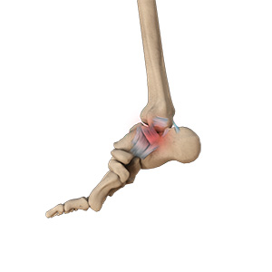 Ankle Sprain Image