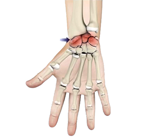 Arthritis Image