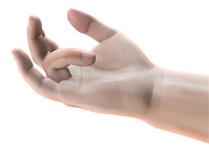Dupuytren's Contracture Image