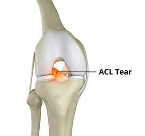 Ligament Injuries Image