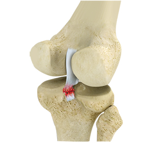 Ligament Injuries Image