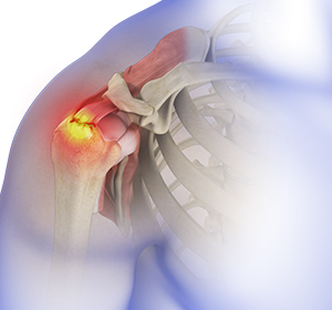 Rotator Cuff Tear Image