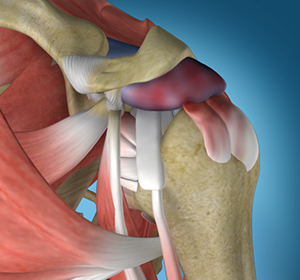 Shoulder Impingement Image