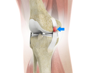 Sprains & Strains Image