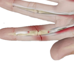 Tendon Injuries Image