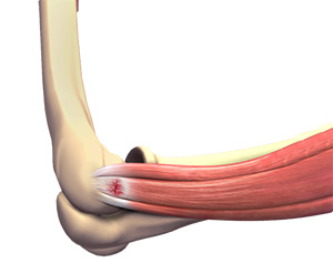 Tennis Elbow Image