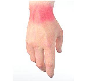 Wrist Sprain Image