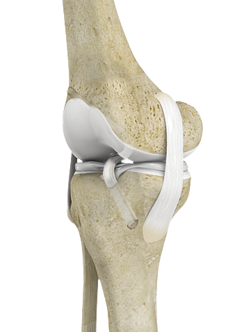ACL Reconstruction