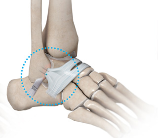 Ankle Stabilization