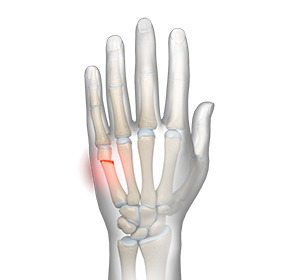 Boxer’s Fracture
