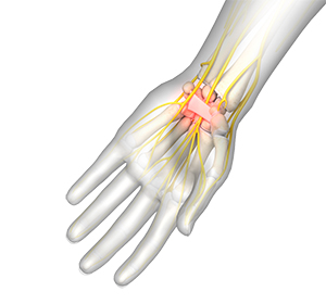 Carpal Tunnel Syndrome