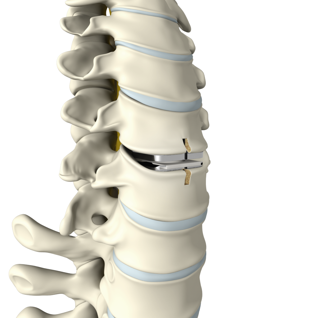 Cervical Disc Replacement