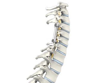 Cervical Spine Fusion