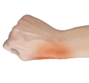 De Quervain’s Tendinosis