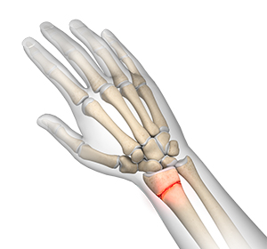 Distal Radius Fracture