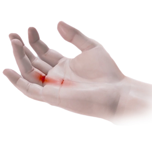 Dupuytren’s Contracture