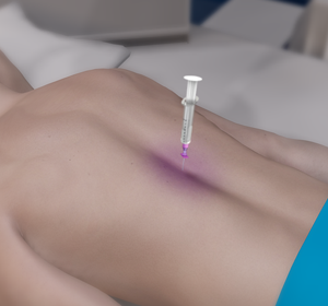 Epidural Steroid Injections 