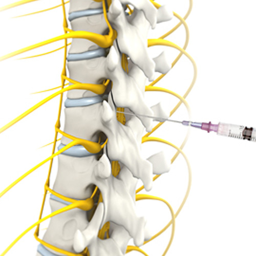 Epidural Spinal Injection