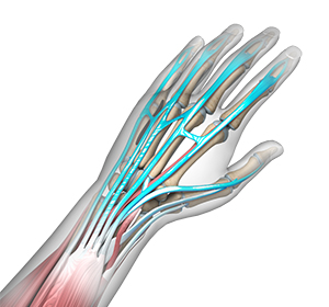 Extensor Tendon Injuries