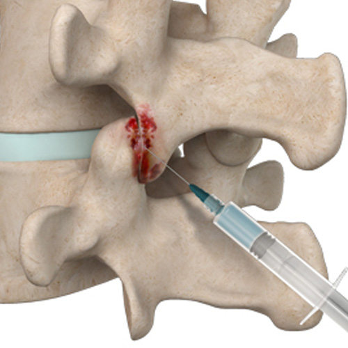 Facet Joint Injections 