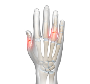 Fractures of the Hand and Fingers