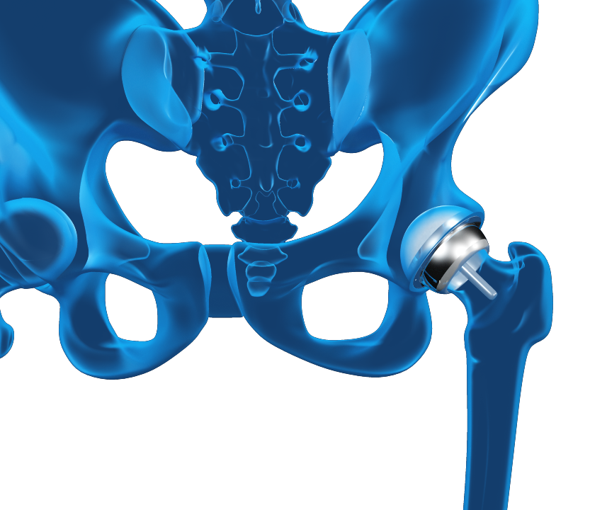 Hip Resurfacing