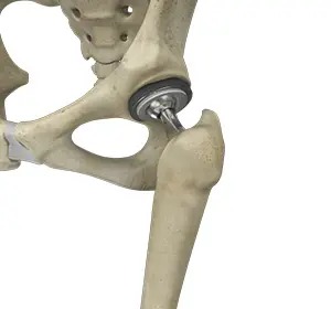 Joint Replacement