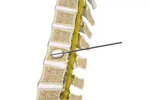 Kyphoplasty
