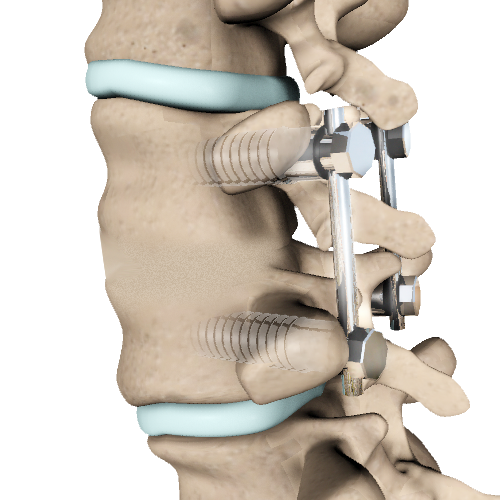 Lumbar Fusion