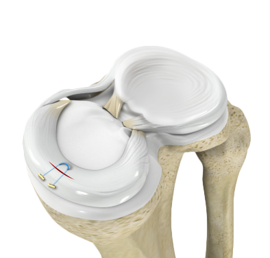 Meniscal Repair Surgery
