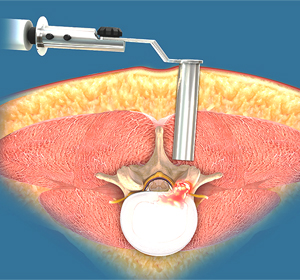Minimally Invasive Spine Surgery