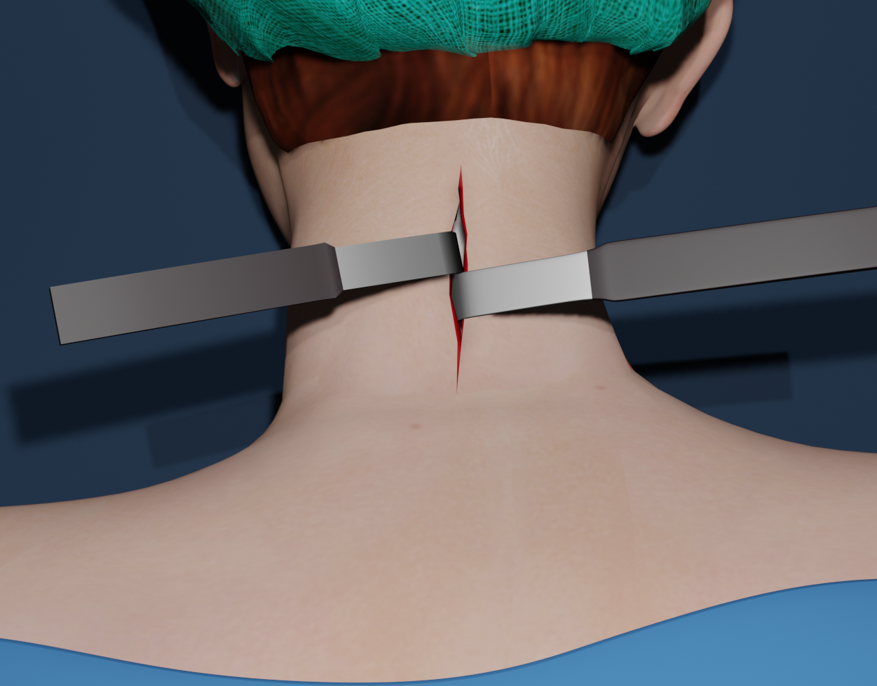 Neck Surgery