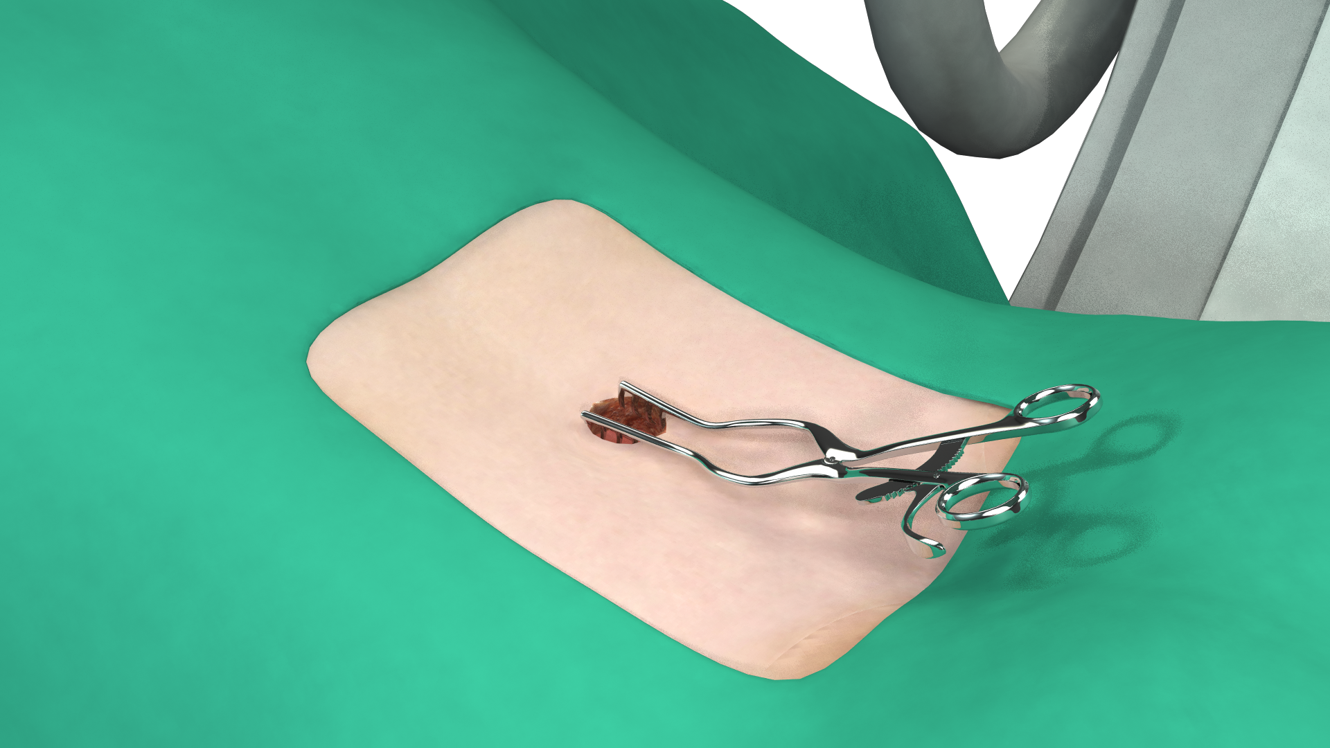 Outpatient Spine Surgery