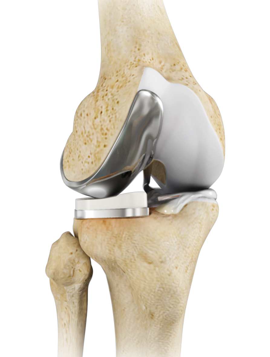 Partial Knee Resurfacing