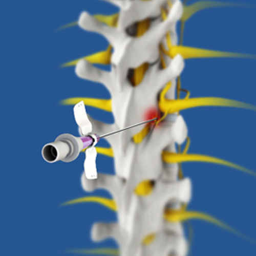 Radiofrequency Ablation