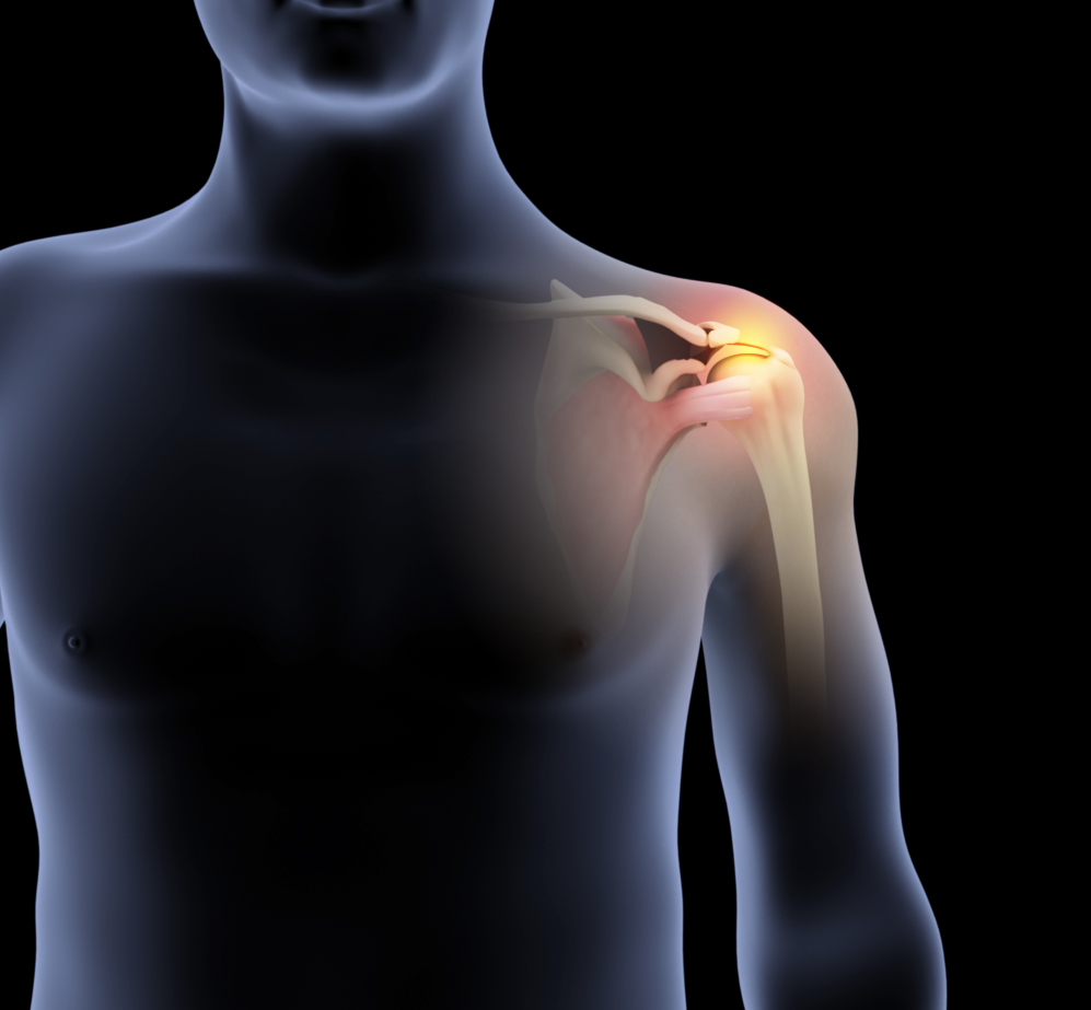 Rotator Cuff Repair