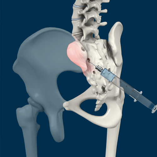 Sacroiliac Joint Injections