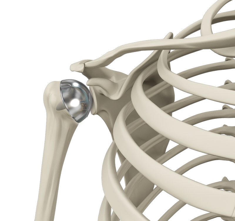 Shoulder Resurfacing
