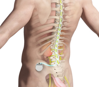 Spinal Cord Stimulation