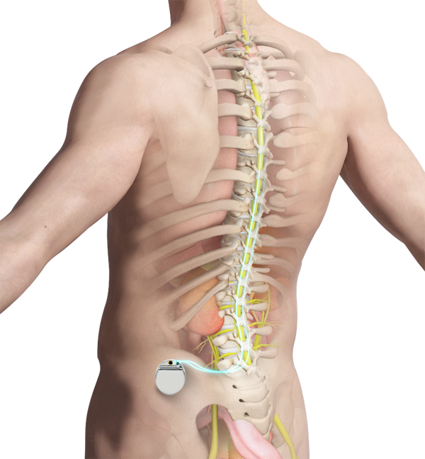 Spinal Cord Stimulator