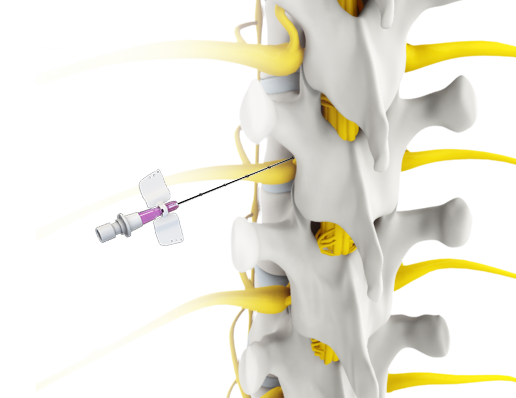 Spine Injections