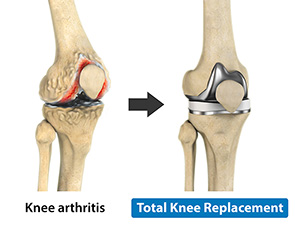 Total Knee Replacement