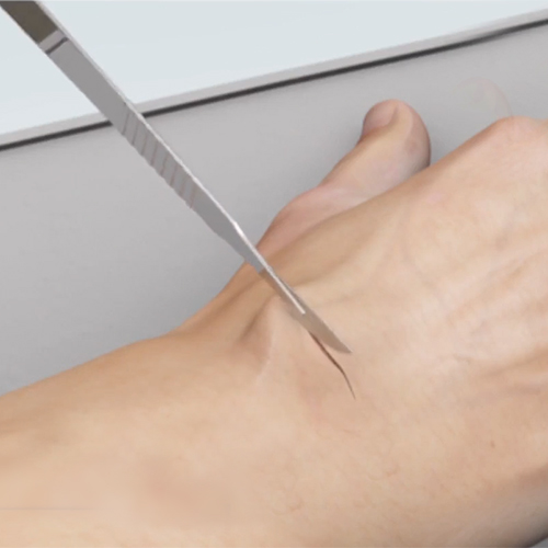 Wide-Awake Hand Surgery