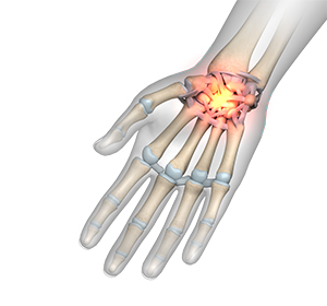 Wrist Injuries